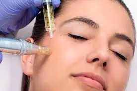 Imagen del Servicio Microneedling